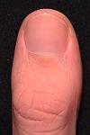 Björn's left thumb