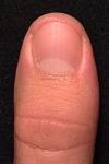 Bonsai's left thumb