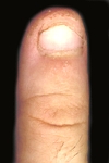 Remi's left thumb