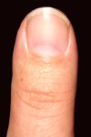 Silvio's left thumb